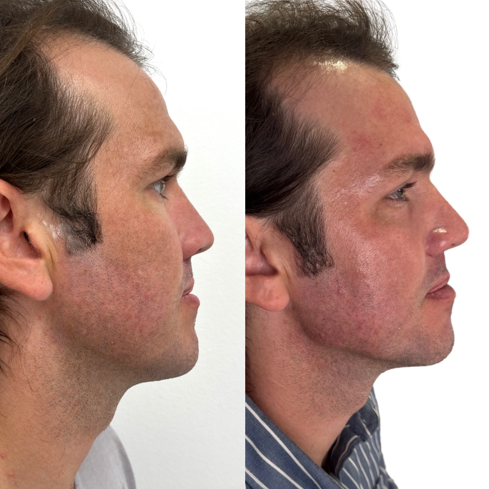 Facial balancing before and after, patient 4