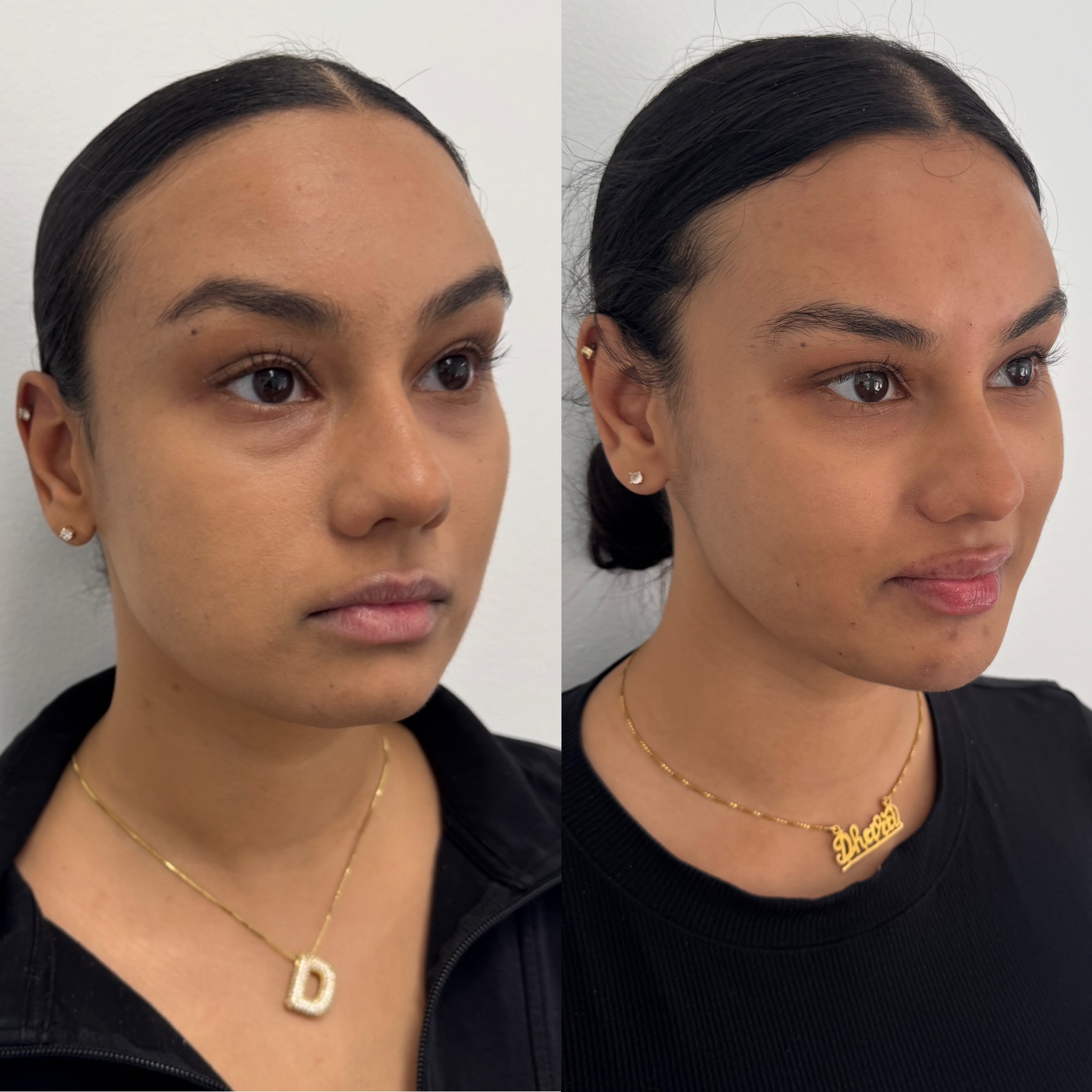 Undereye filler before and after, patient 3